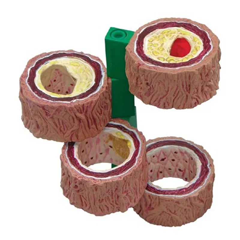 

Human Body 4-Piece Artery Model Anatomical Replica Model Sclerosis And Thrombus Model