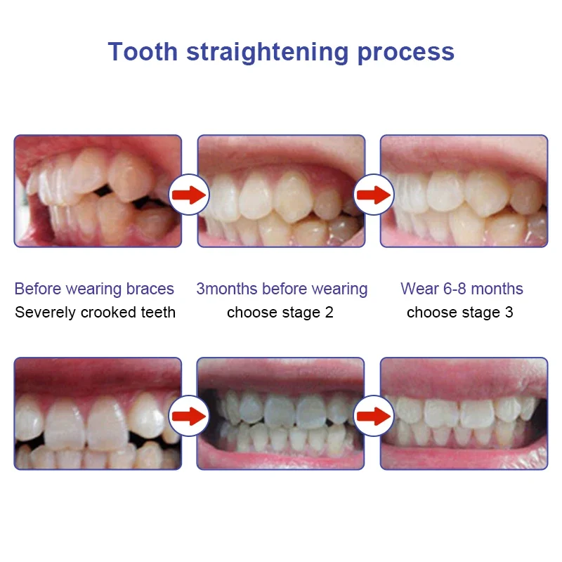 Orthodontic Braces Dental Braces Smile Teeth Alignment Trainer Silicone 3 Stages Teeth Trainer for Adults Tooth Correction Aids