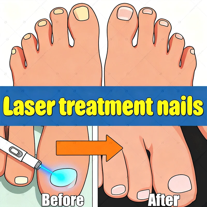 Il laser della generazione-2 dice addio al fungo delle unghie in 7 giorni