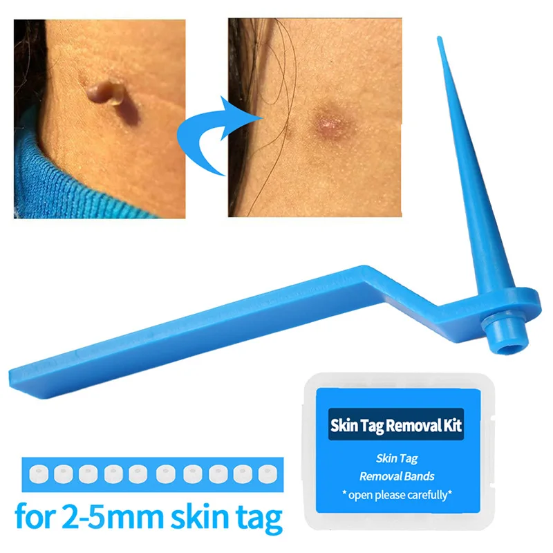 1Set Skin Tag Skin Mole Wart Remove Cleaning Tool Micro Skin Tag Removal Kit With Cleansing Swabs Adult Mole Wart Face Care Kit