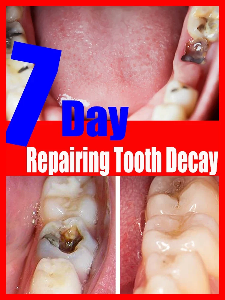 Tooth Decay Repair All Cavities