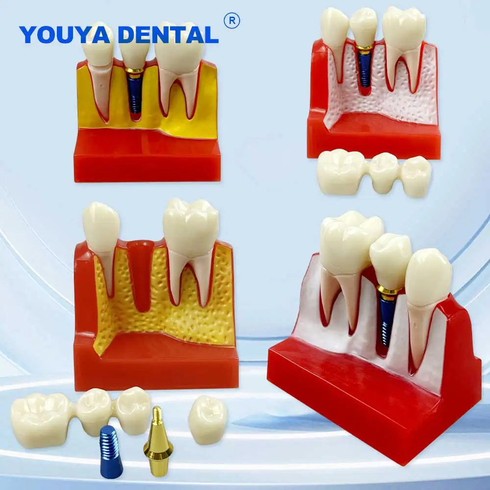 

Съемная 4-кратная модель Typodon, модель имплантата, анализ, коронный мост, демонстрация, стоматология, исследование, коммуникационная модель зубов