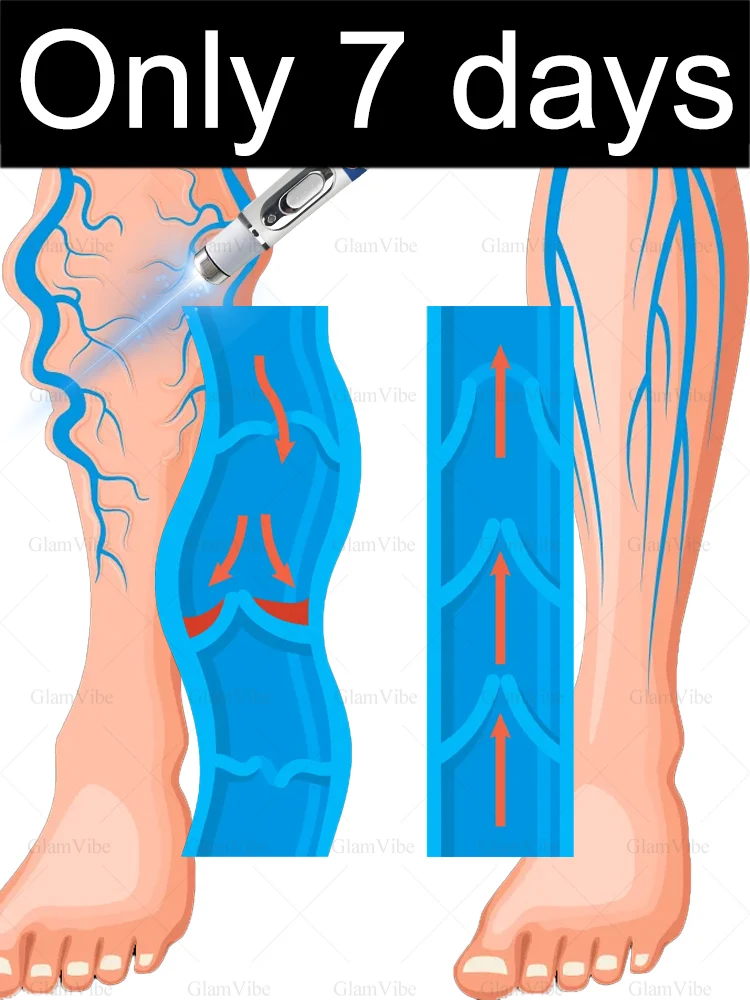 Say goodbye to "bulging veins"