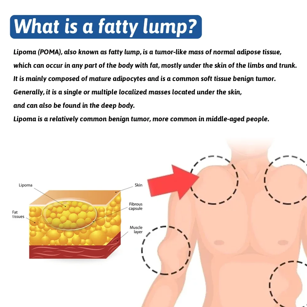 Спрей Lipoma для снятия жидкости, 50 мл