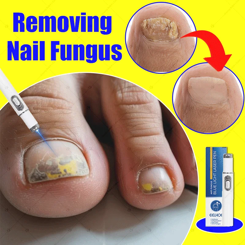 

Nail Fungus Laser Pen Blue Light Therapy laser pen for Foot Care