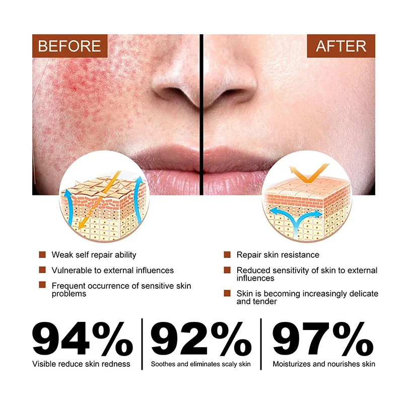 B5 reparação creme de vermelhidão facial instantâneo aranha veia remover pele sensível calmar anti vermelhidão rosacea tratar loção cosméticos coreano