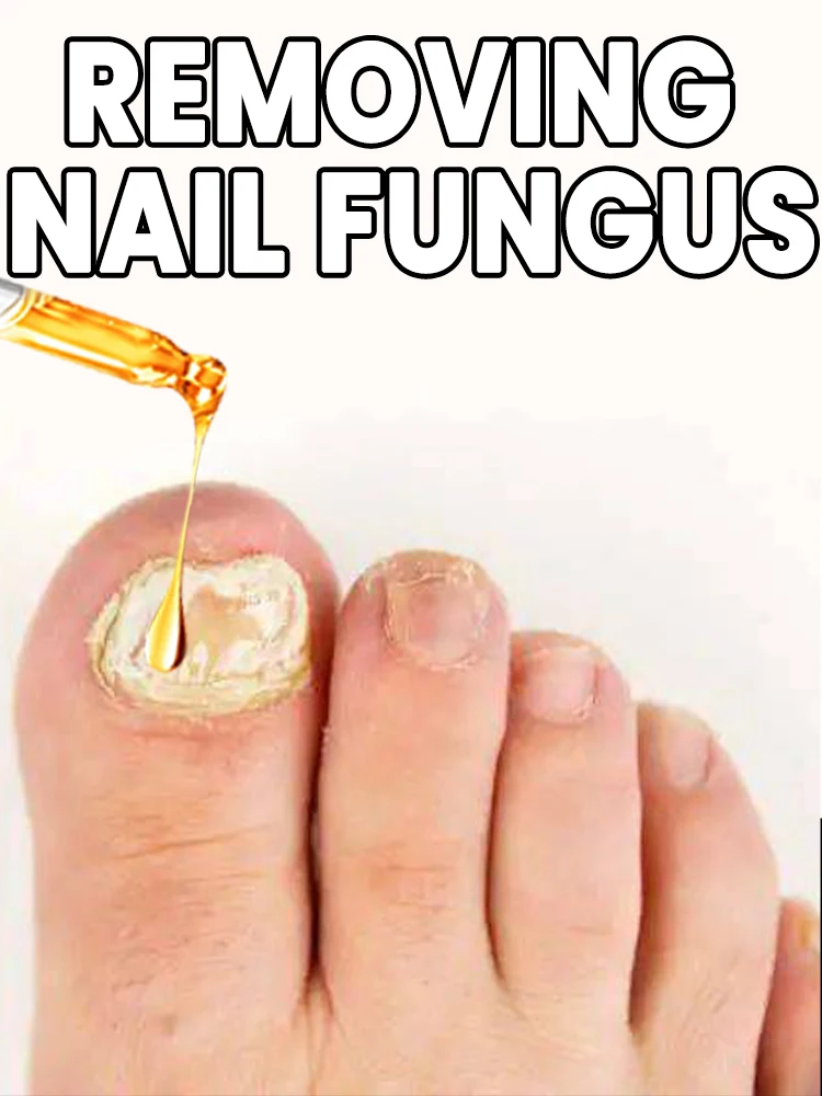 

Eliminate Nail fungi Eliminate Nail fungi