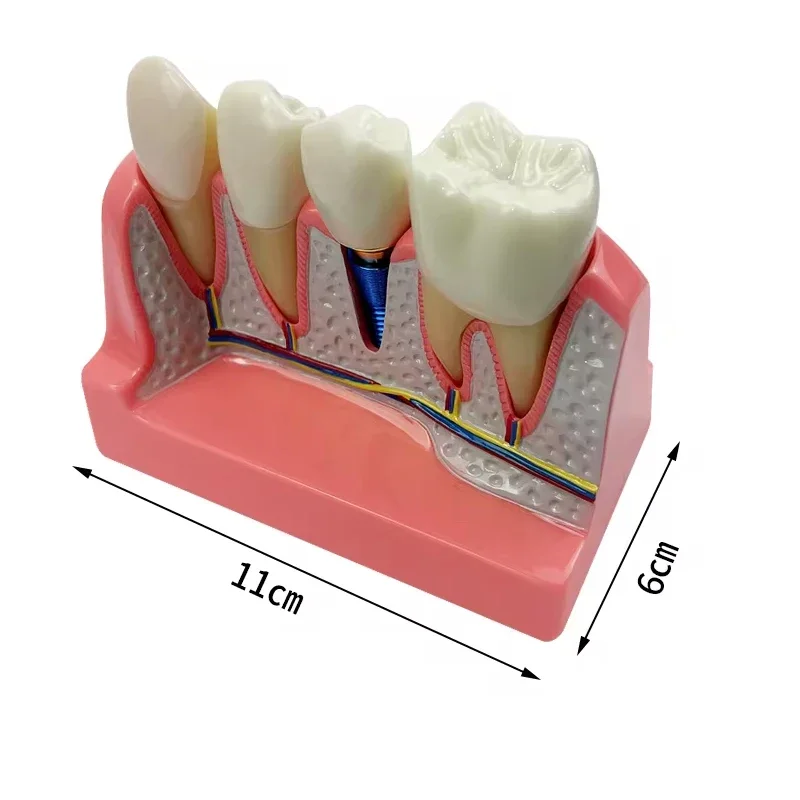 4 Times Dental Implant Teeth Model Analysis Crown Bridge Demonstration Removable Model Dentist Teaching Study Training  Model