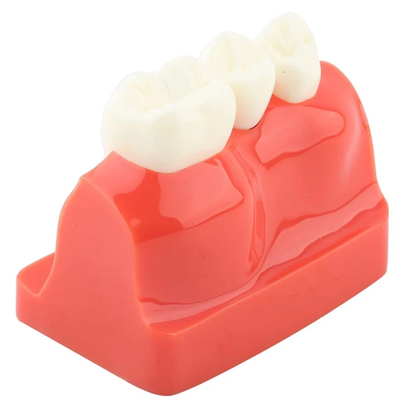 Teeth Demonstration Model Implant Removable Analysis Crown Bridge For -Patient Communication