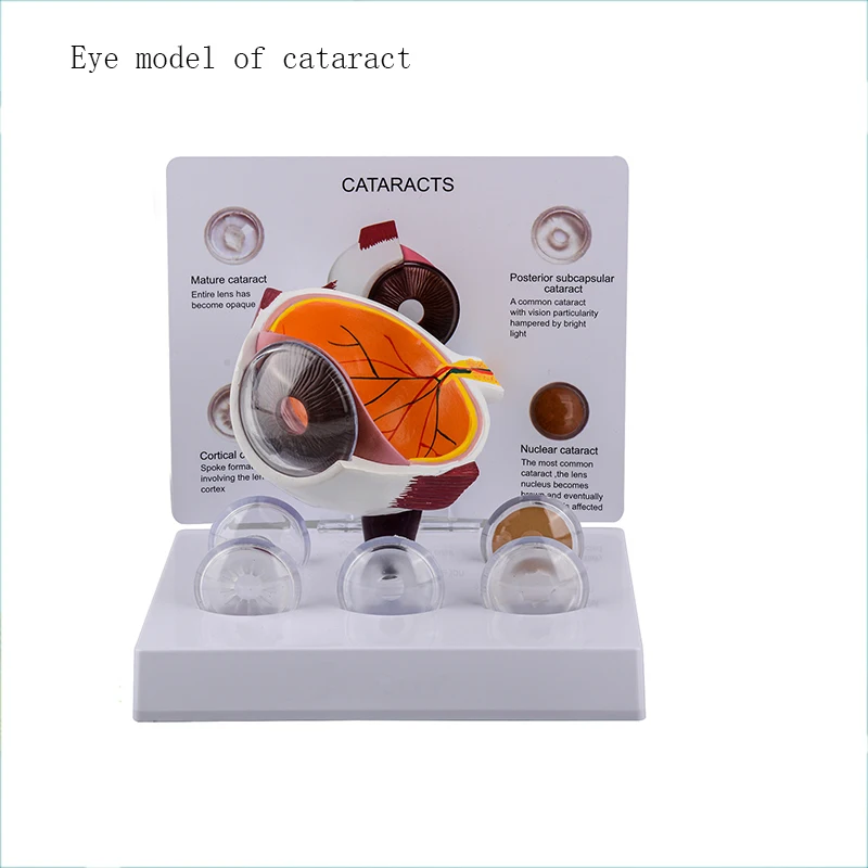 The model of the structure of the Cataract eyeball and the model of the Glaucoma eyeball