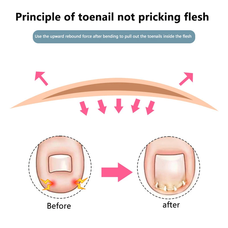 Herramienta profesional de corrección para el cuidado de los pies, herramientas correctoras de uñas encarnadas, recuperación de pedicura, ayuda para el cuidado de las uñas del dedo del pie, 2 uds.