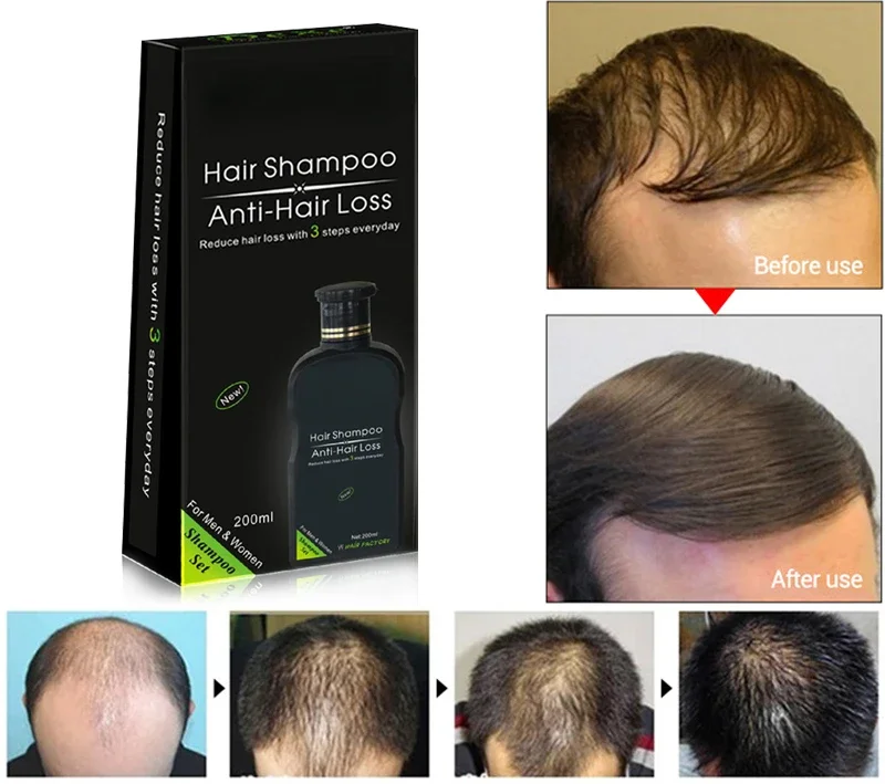 Professional Hair Growth Shampoo Anti-Hair Loss Chinese Hair Treatment Product for Preventing Hair Fall