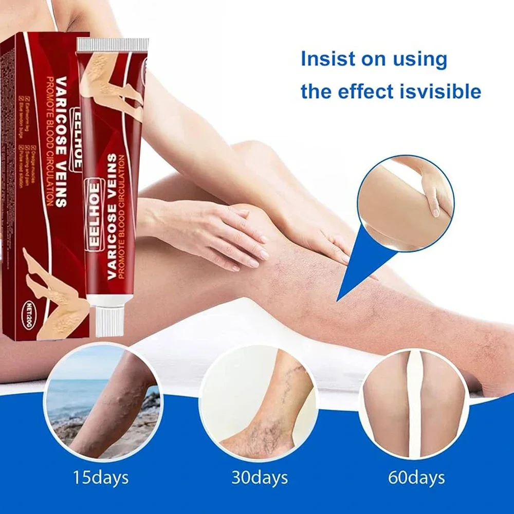 Improvement of moderate varicose veins, relief of pain, and improvement of blood circulation