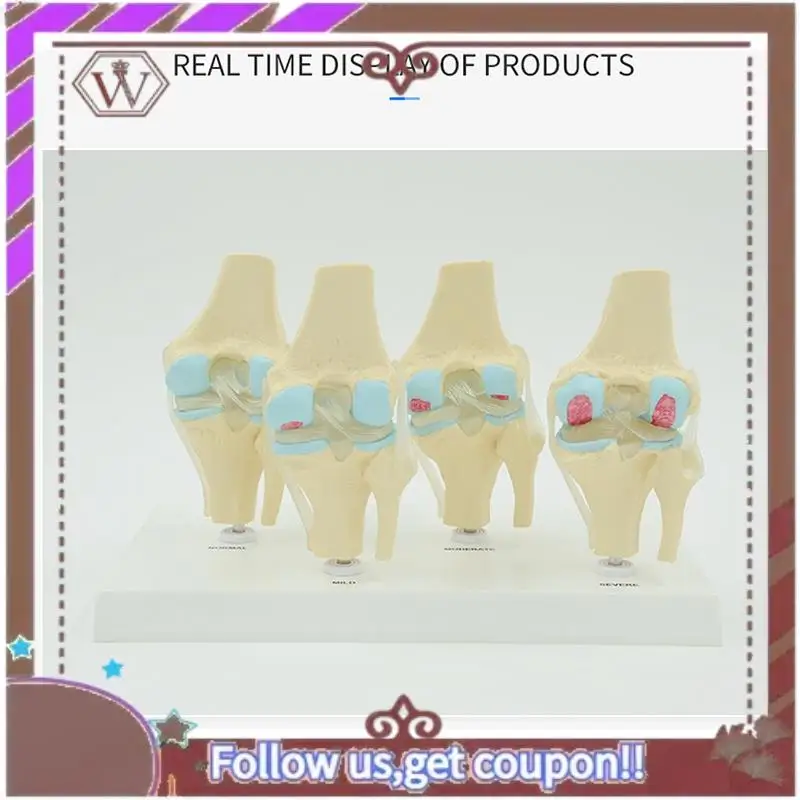 

Latest Anatomical Human Degenerative Knee Joint Model Skeleton Anatomy Teaching Resources