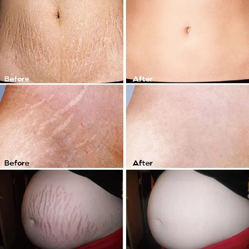 Stretch Marks Permanent Removal Serum Effective Treatment Stretch Marks Burn Surgical Scars Anti-Aging Firming Smooth Body Care