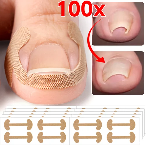 20/100 Uds. Adhesivo profesional para corrección de uñas encarnadas, Corrector de uñas para pies, almohadilla de tratamiento para pedicura, herramientas de cuidado de la salud