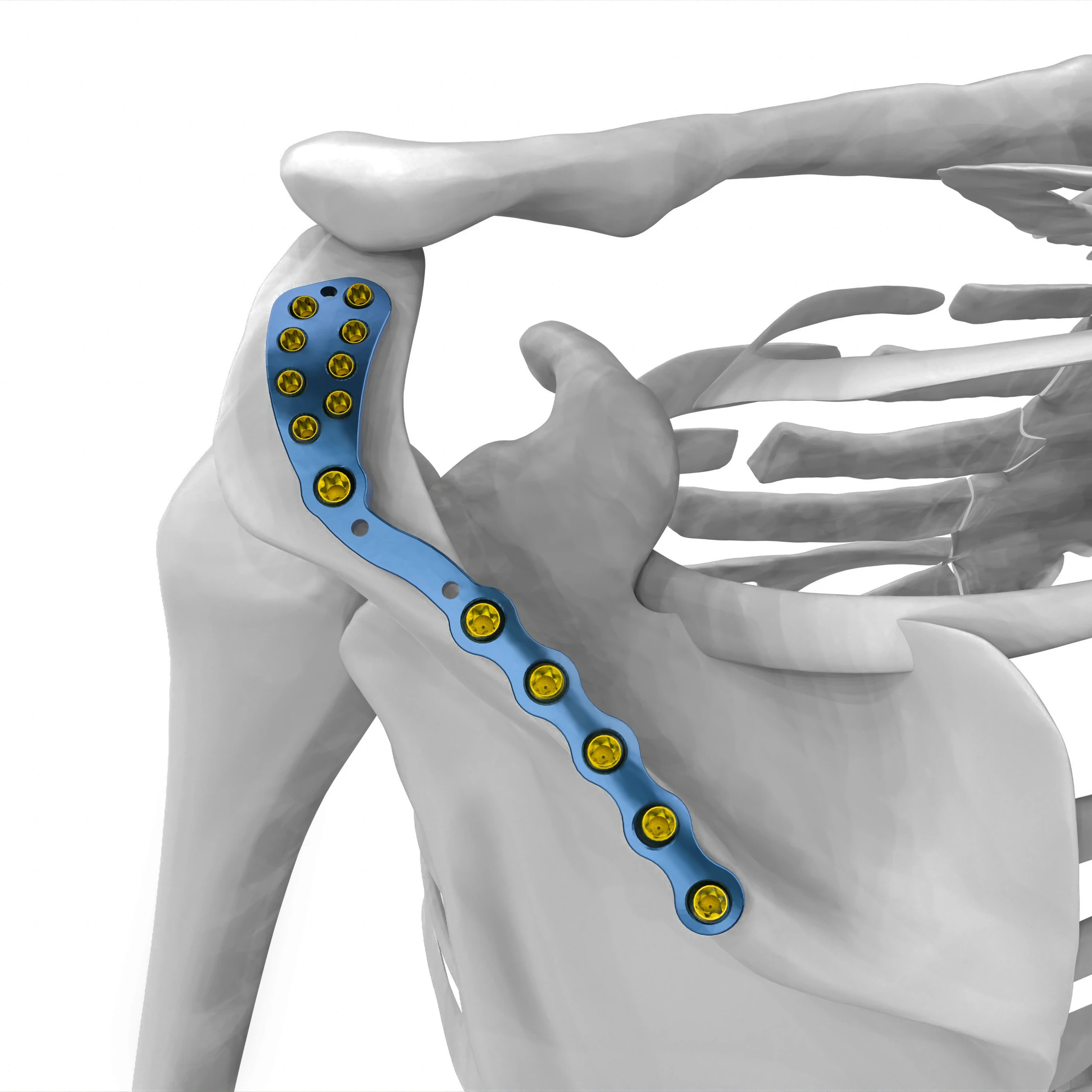 Joint bone Surgical Implants Spinal Screw  Implants & Interventional Materials for L Locking Plate