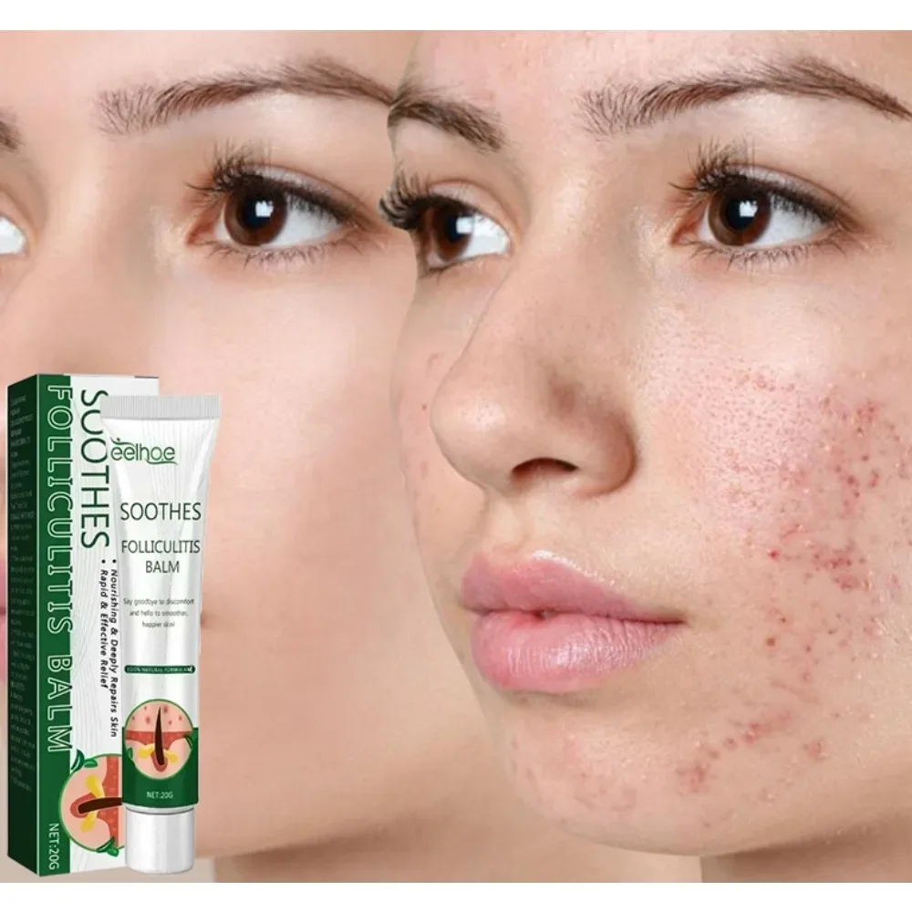 

Acne Remover Face Serum Herbs Acne Treatment Pimple Remover Shrink Pores Oil Control Face Herb Acne Skin Care