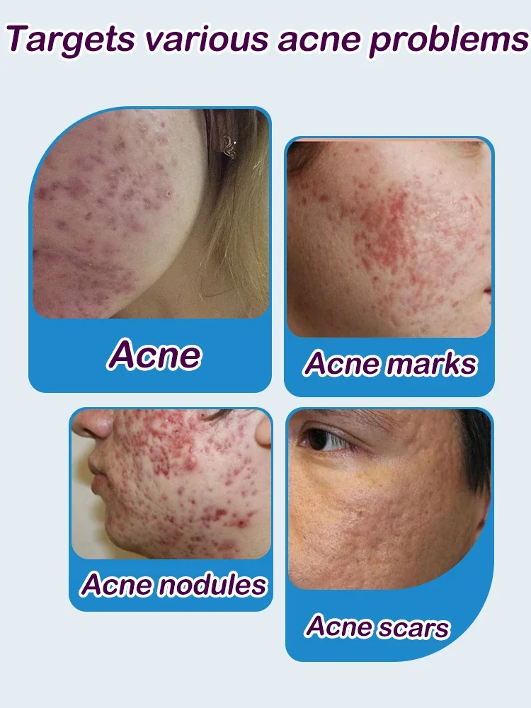 acne laser anti Acne serum