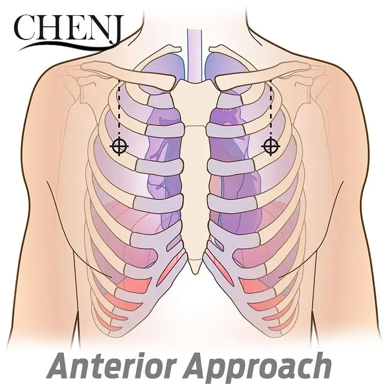 Design Notfall ausrüstung Erste-Hilfe-Kit Spannung Pneumothorax Thorax Nadel medizinische Brust Dekompression nadel