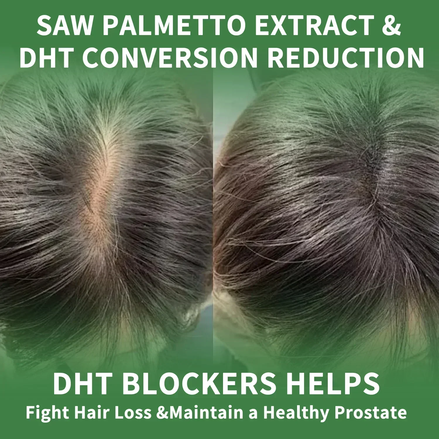 Saw Palmetto - Help Promote Prostate Health, Reduce Baldness and Thinning Hair, Urinary System Health