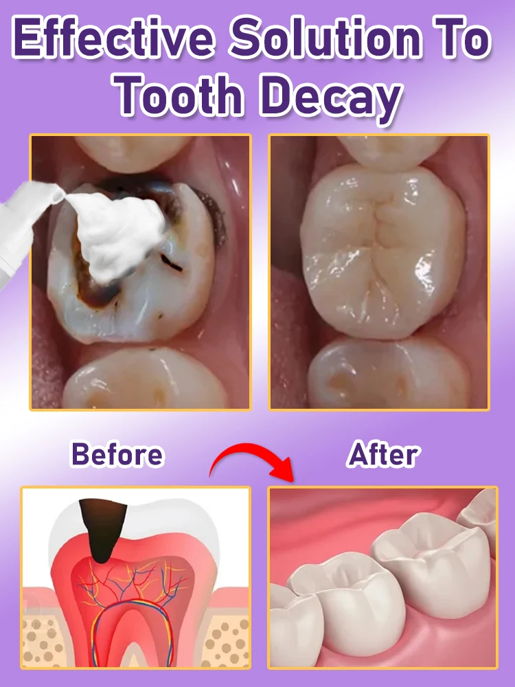 

teeth decay repair tooth repair fast teeth whitening clean & teeth teeth repair cavities tooth repair treatment plan