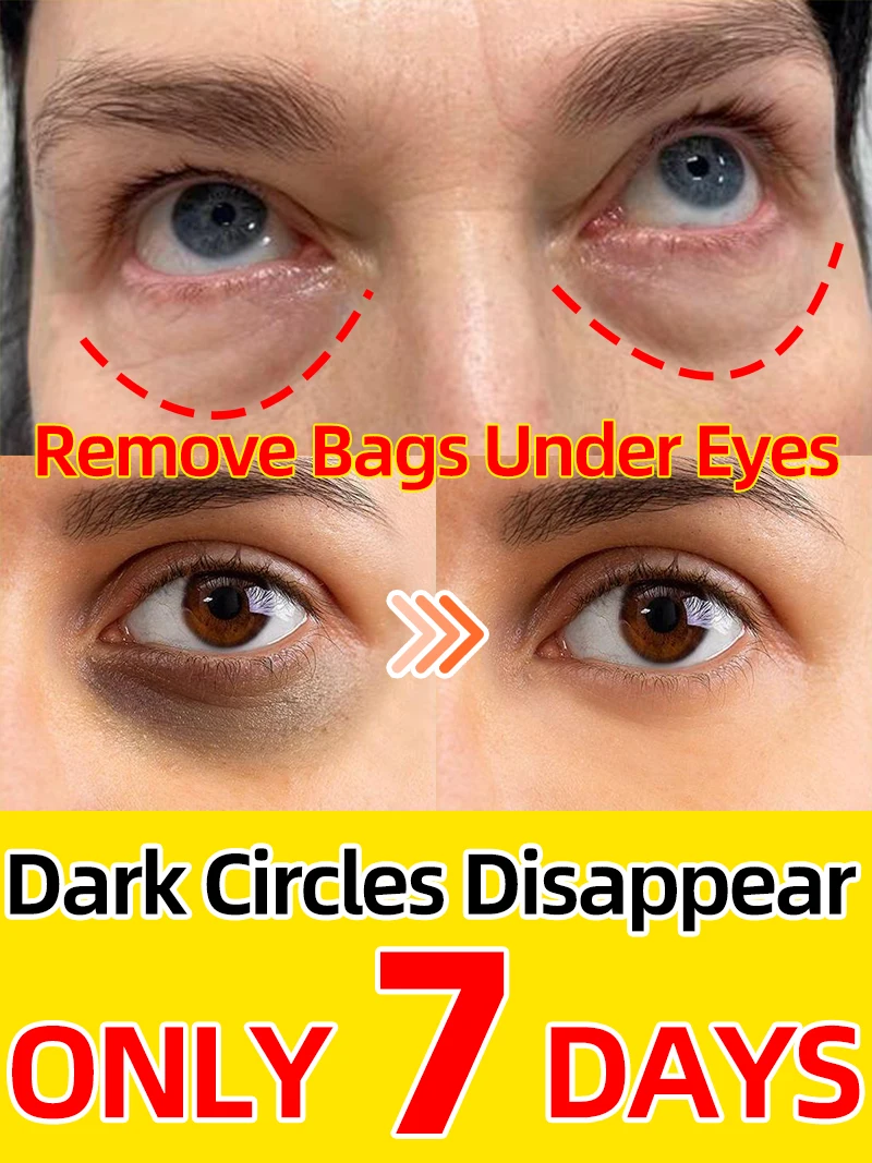 

removal dark circles