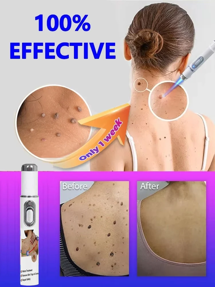 

Deep Sterilization Laser Pen Treatment for Flat Warts Condyloma Acuminatum and Various Warts Physical Painless Removal of Warts