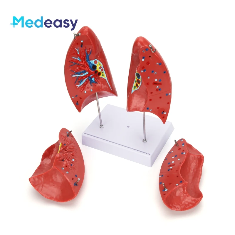 Detachable Human Anatomy Lung Anatomical Model