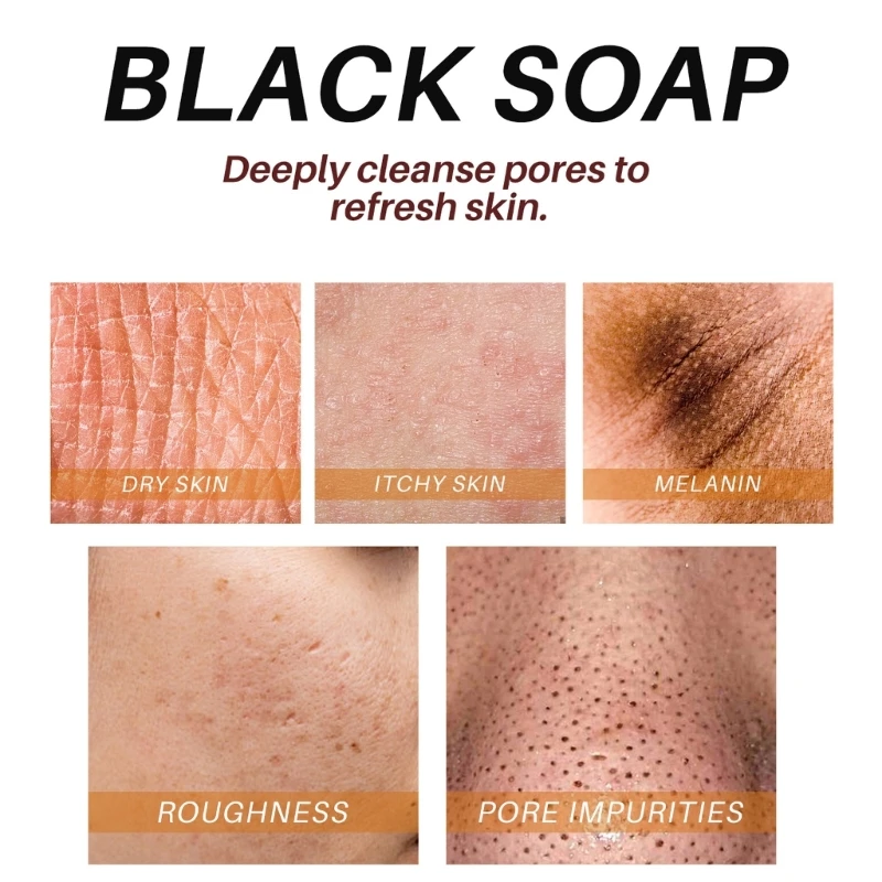 สบู่ดำแอฟริกัน Anti Rebelles Beauty Moisturizing Natural Bath Treatments Dropshipping