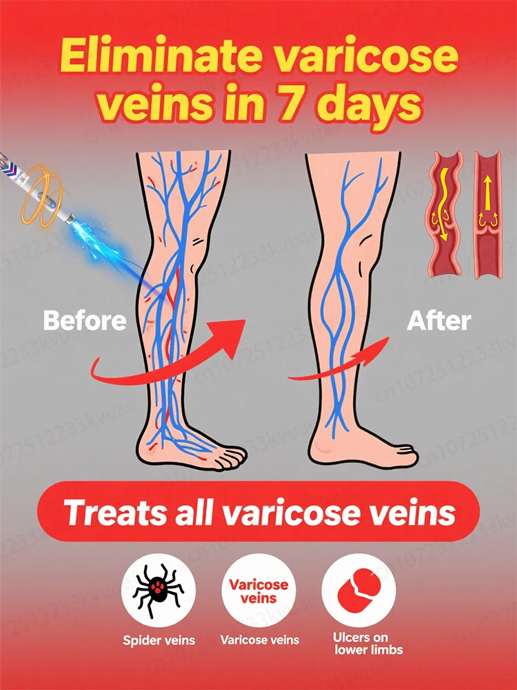 

Generation-2 Laser Says Goodbye To Spider Legs Varicose In 7 Days