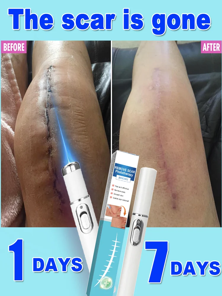 

No skin troubles - Laͣs͛eͤrͬ s͛cͨaͣrͬ rͬeͤmͫoͦvͮaͣl