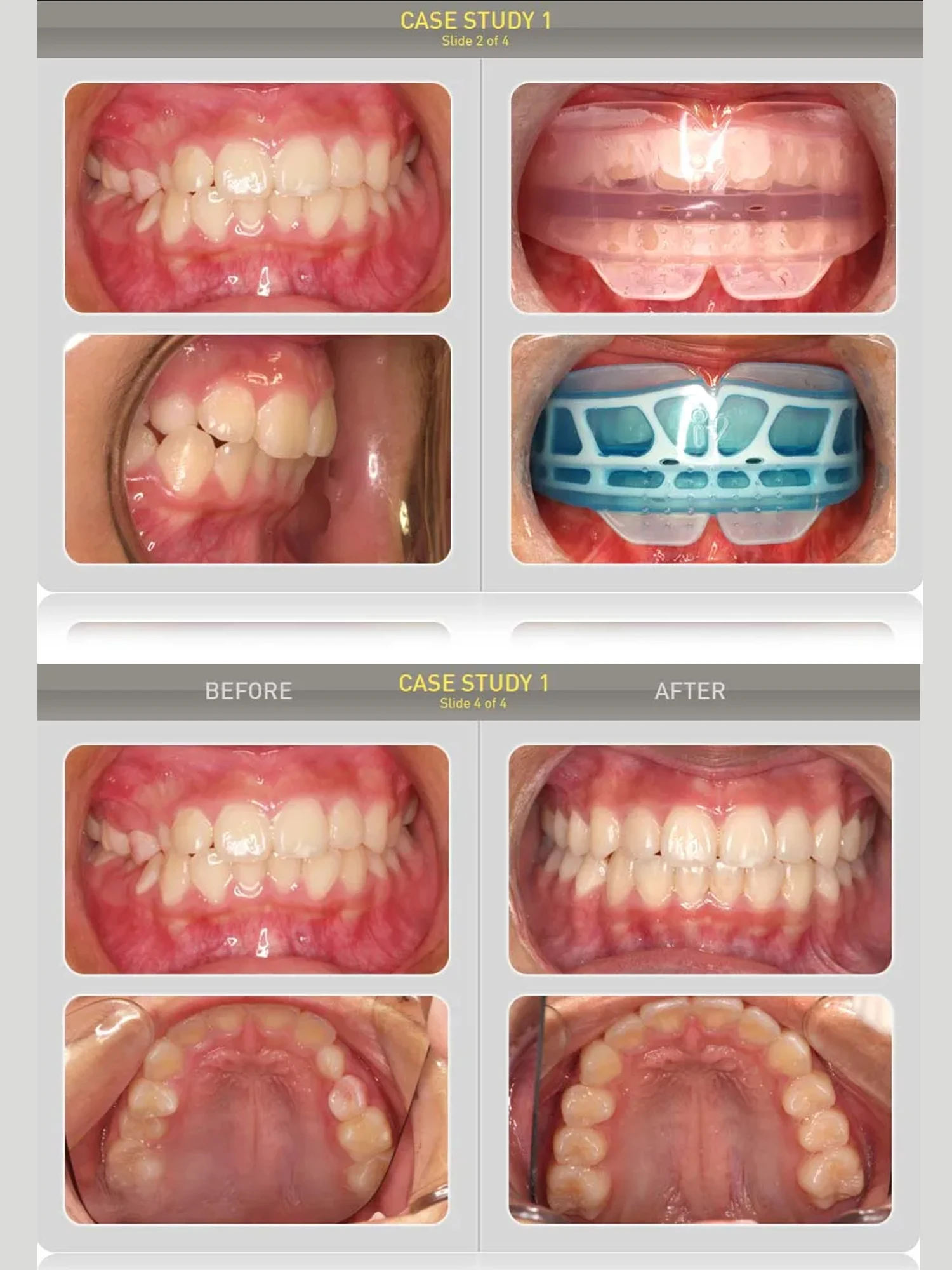 Mrc Orthodontic Bra…