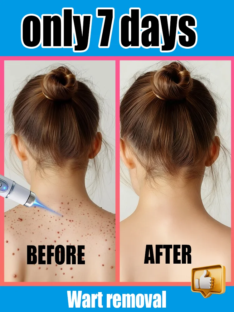 ᴛʜɪʀᴅ ɢᴇɴᴇʀᴀᴛɪᴏɴ Bʟᴜᴇ Lɪɢʜᴛ Pᴇɴ:Pʀᴇᴄɪsᴇ ᴡᴀʀᴛ ʀᴇᴍᴏᴠᴀʟ