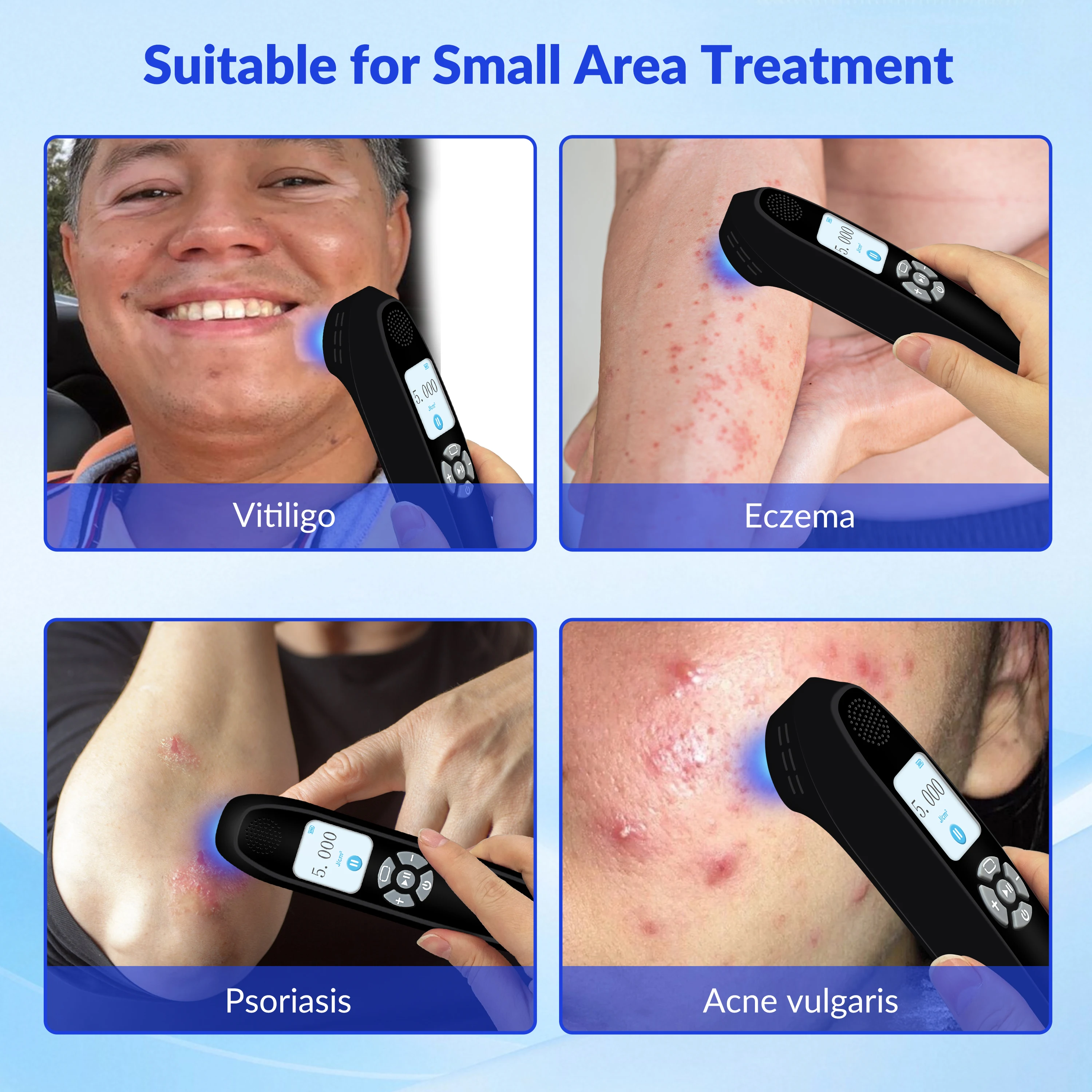 

ZJZK Home Therapy Vitiligo Psoriasis Eczema Skin Diseases Machine Ultraviolet UVB Light Treatment Device 308nm Skin Health
