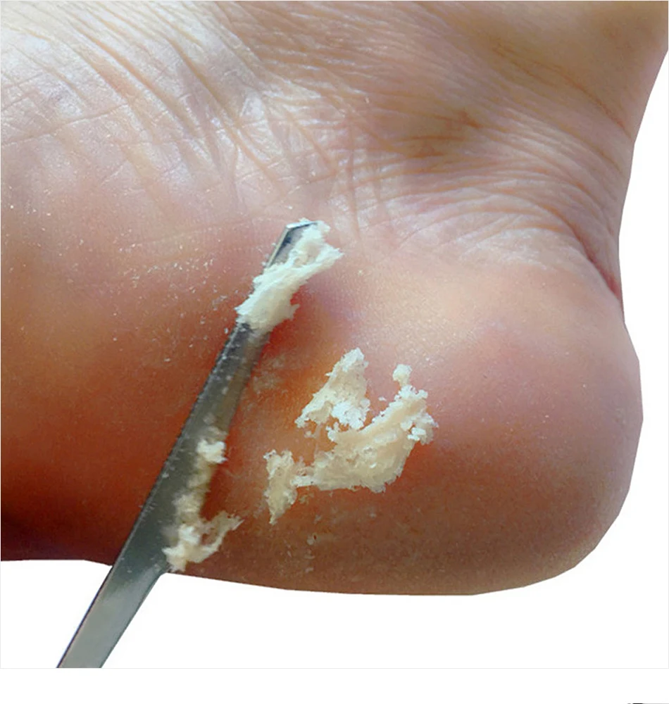 Arquivo de pé de aço inoxidável e removedor de calos ferramenta de pedicure para pele morta pele dura dedo do pé unhas calcanhar cuidados