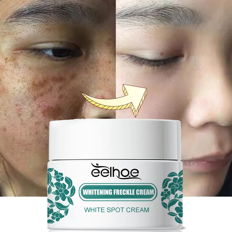 Niacinamide Whitening Freckle Cream Effective Remove Dark Sports Reduce Melanin Melasma Brighten Lighten Dull Skin Care Products