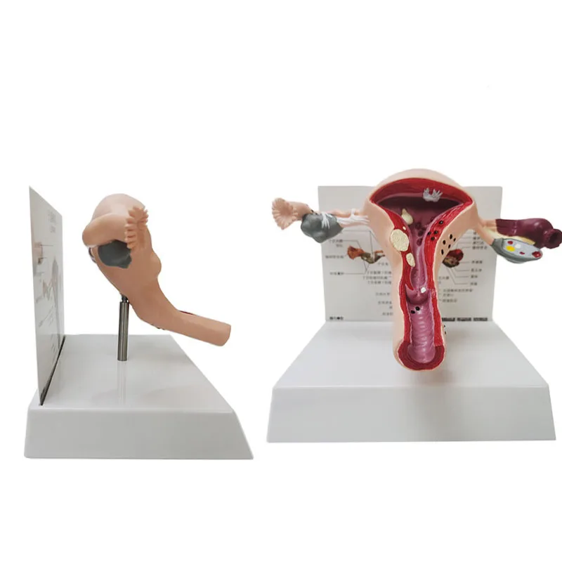 Medical Human Pathological Uterine And Ovarian Anatomical Model Gynecological Display Medical Teaching Supplies