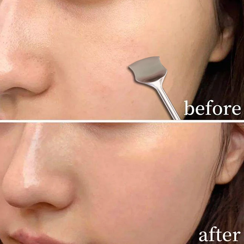 Extracteur de Points Noirs Professionnel 2 en 1 en Acier Inoxydable, Outil d'Extraction des Imperfections, des lèvent et des Comédons pour le Visage