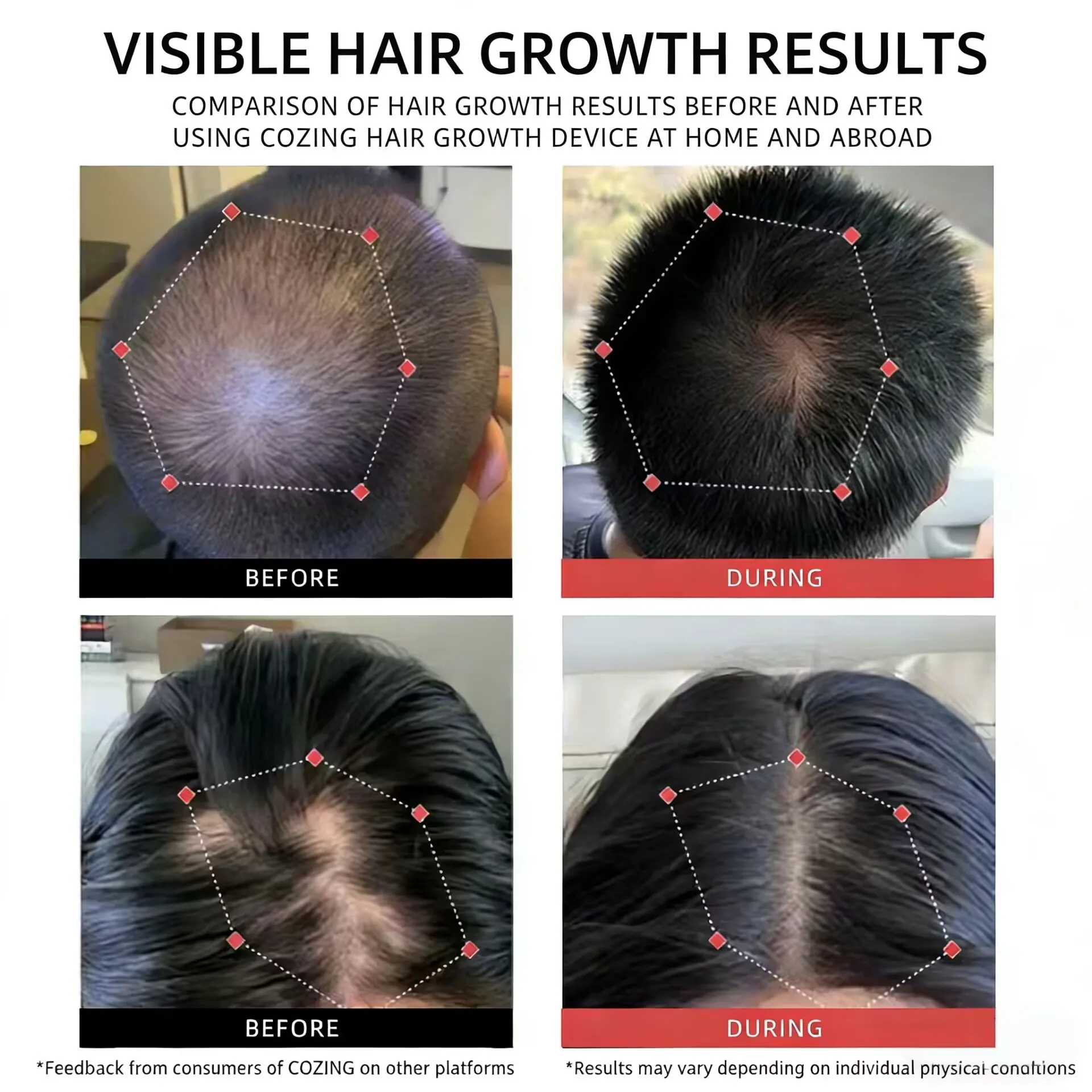300 Diode Laser Cap for Hair Growth with Intelligent Timer, 650nm Red Light Therapy for Thinning Hair, Portable Home Use Device