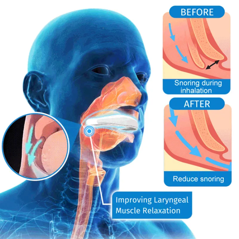 Aparelhos multifuncionais para homens e mulheres, aparelhos especiais para antisnoring e antisnoring