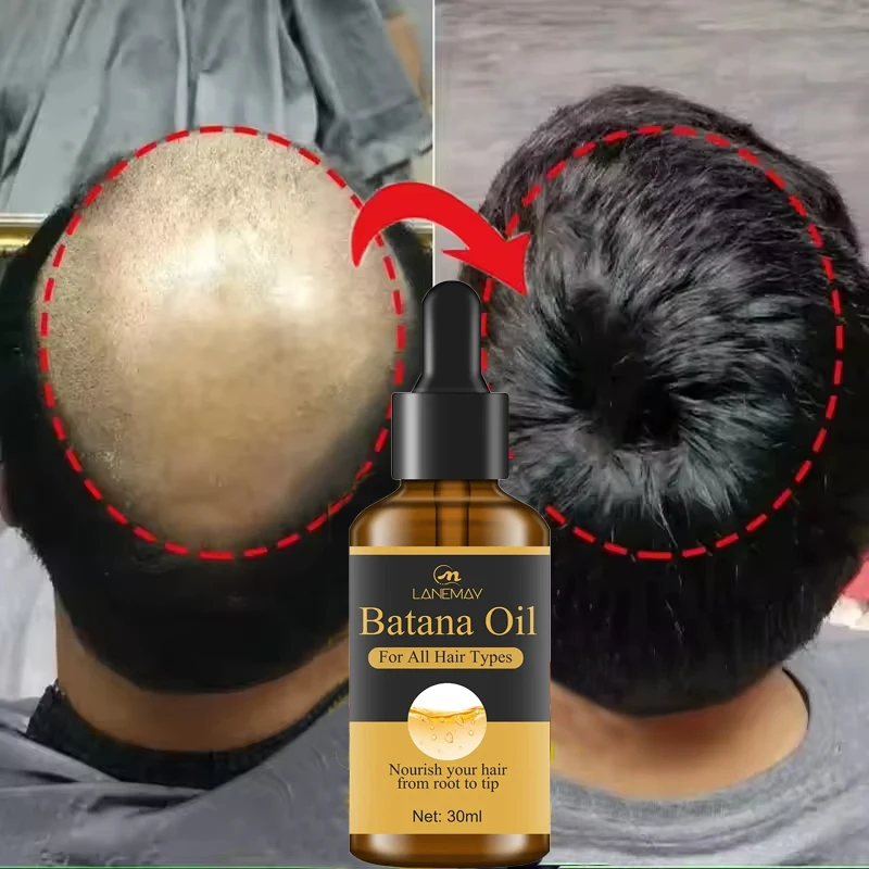 Aceite de Batana rápido de 7 días, suero para el crecimiento del cabello, productos antipérdida para el crecimiento del cabello, reparación de raíces del cabello dañadas, cuidado del cabello para mujeres y hombres