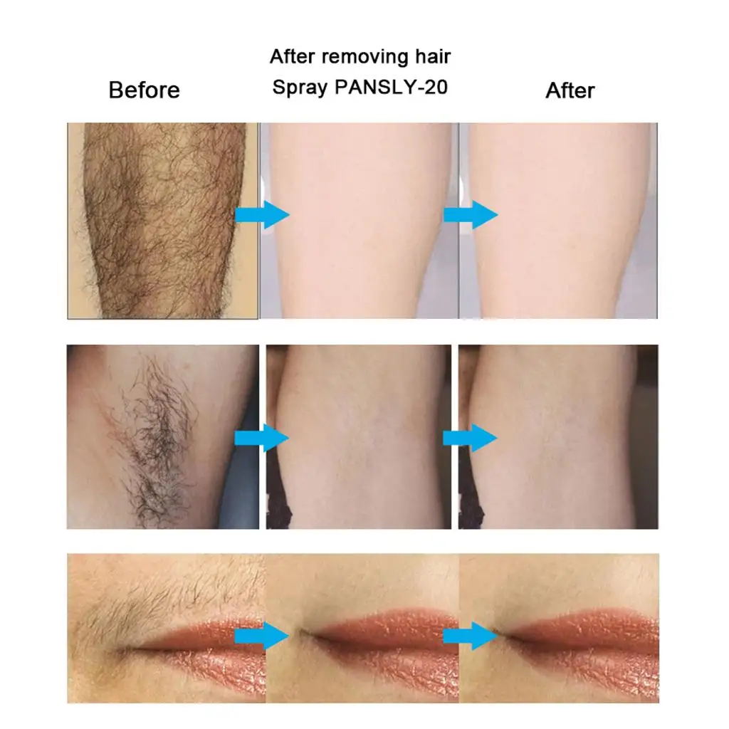 spray-para-remocao-de-pelos-50-ml-inibe-o-crescimento-de-pelos-creme-para-remocao-facial-spray-para-barba-zonas-intimas-rosto-pernas-corpo-e-axilas-sem-dor