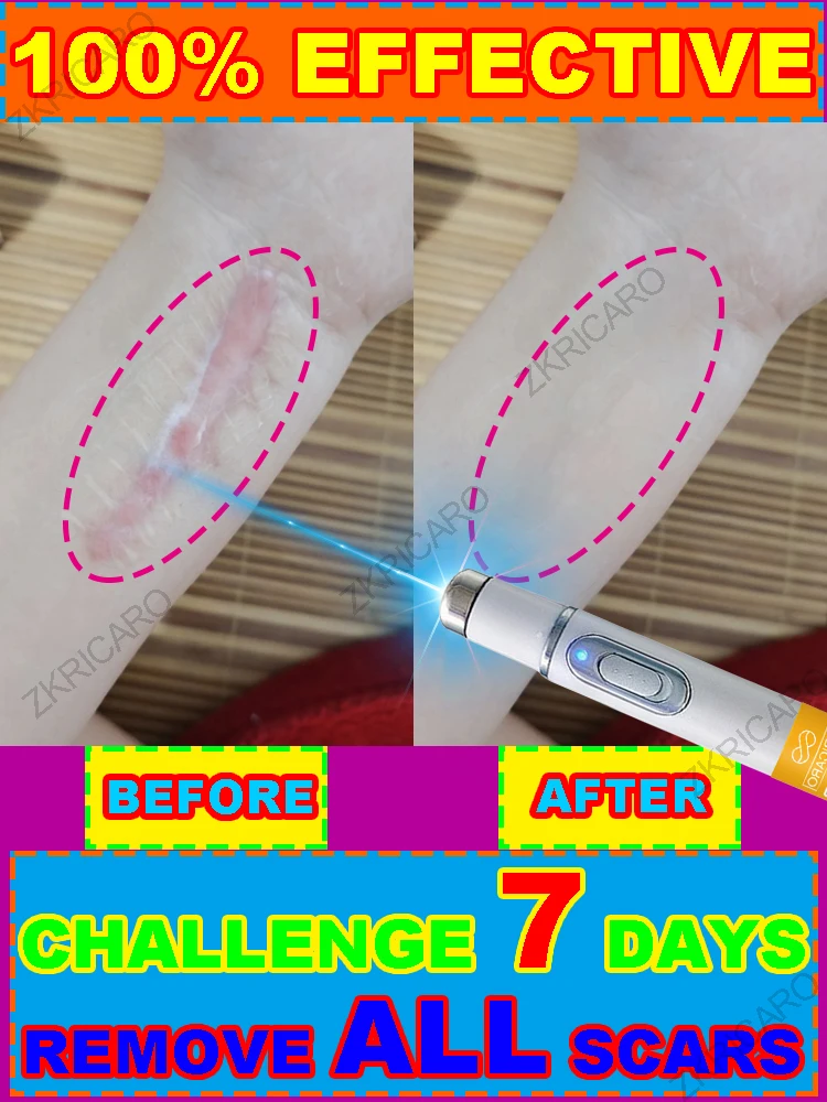 

Want to remove scars Try this!