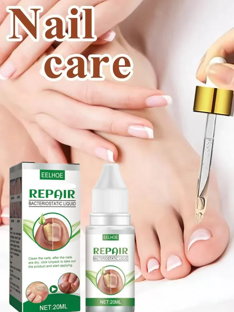 Nail 𝐅𝐮𝐧𝐠𝐮𝐬 𝐓𝐫𝐞𝐚𝐭𝐦𝐞𝐧𝐭 𝐎𝐧𝐲𝐜𝐡𝐨𝐦𝐲𝐜𝐨𝐬𝐢𝐬 𝐑𝐞𝐩𝐚𝐢𝐫 Herbaceous Essential oil For 𝐏𝐚𝐫𝐨𝐧𝐲𝐜𝐡𝐢𝐚