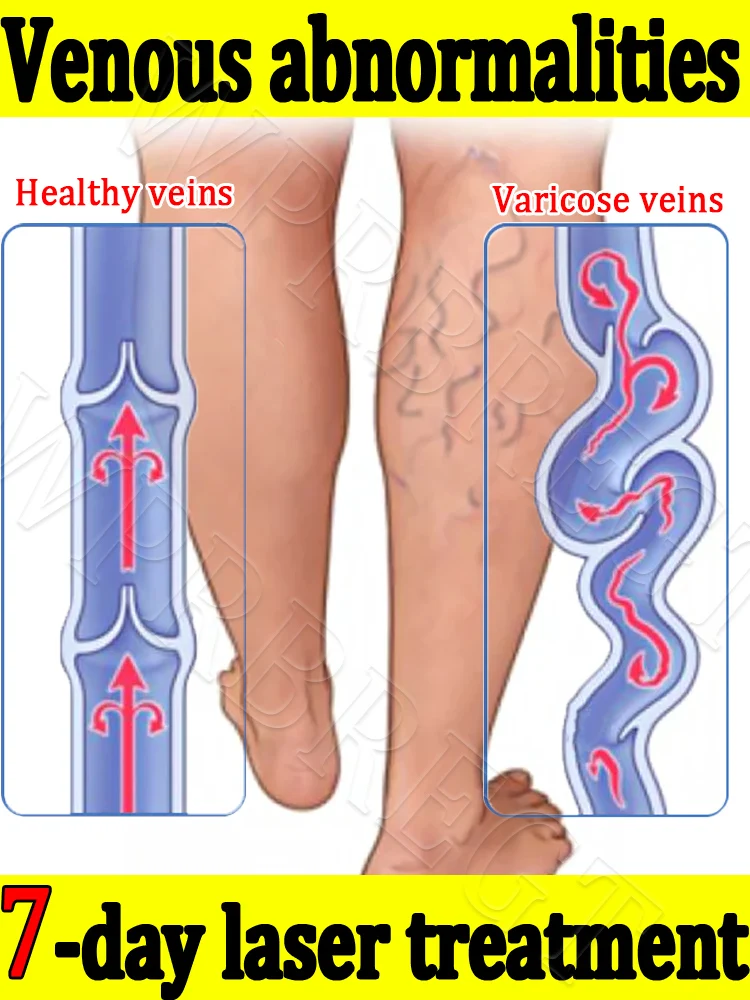 

Снимает флебит ноги и расширенный васкулит.