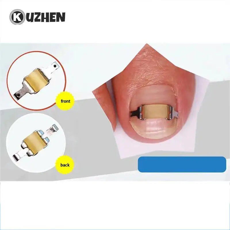 1Set Ingrown Toenail Corrector Tools Pedicure Professional Ingrown Toenail Correction Foot Care Recover Embed Toe Nail Treatment