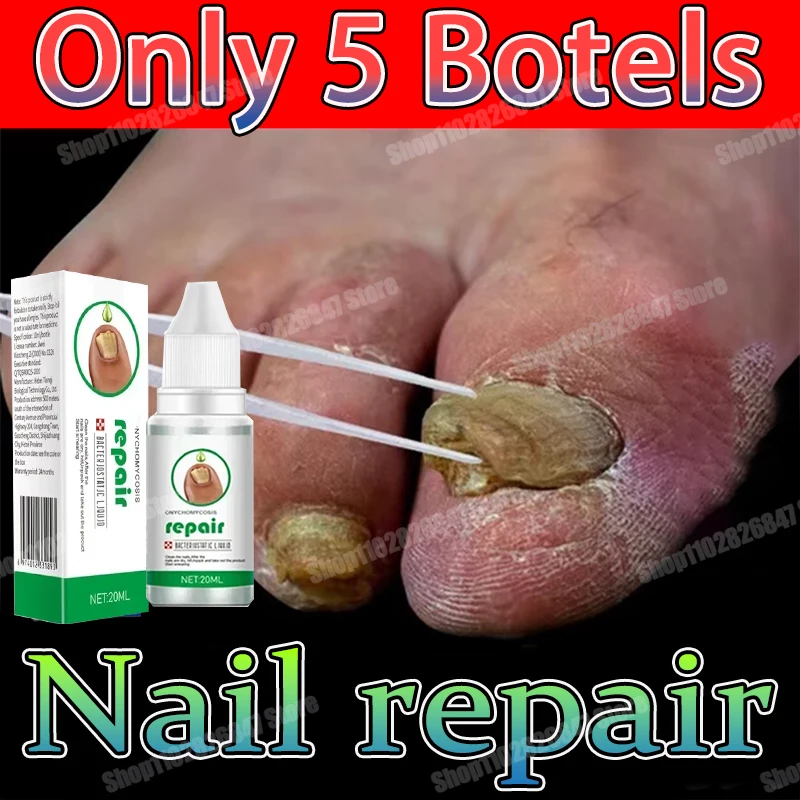 Toenail Nail Fungus Treatment Repair Fingernail Device Toenail Treatment for Foot Nail Fungus Essential Oil Onychomycosis Care