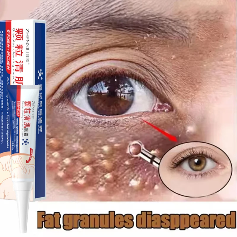 

Fat Granules Remover Eye Cream Effective Remove Fat Granules Puffiness Anti-Particles Milia Remover Product Repair Eye Skin Care