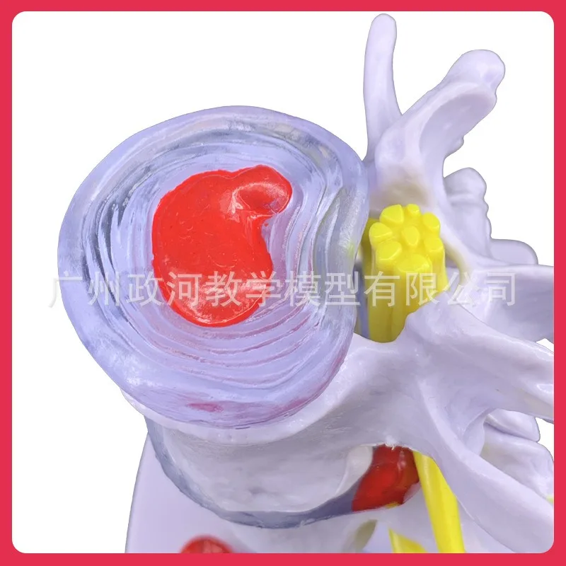 Human Lumbar Disc Herniation Anatomy Model Skeletal Pathology